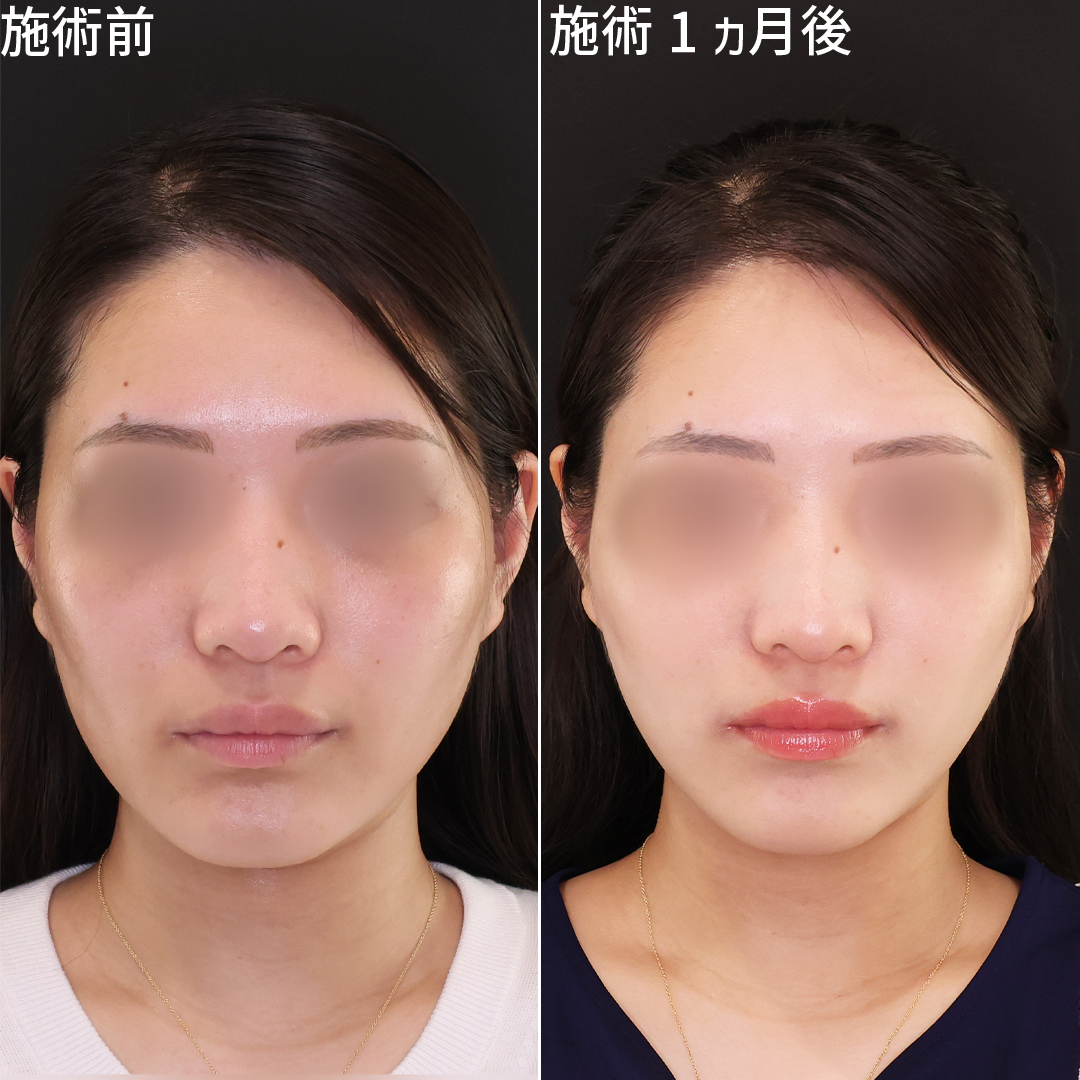 綺麗に可愛くなれる！Dr.モリモリの小顔脂肪吸引×糸リフト【ジョールファット除去】