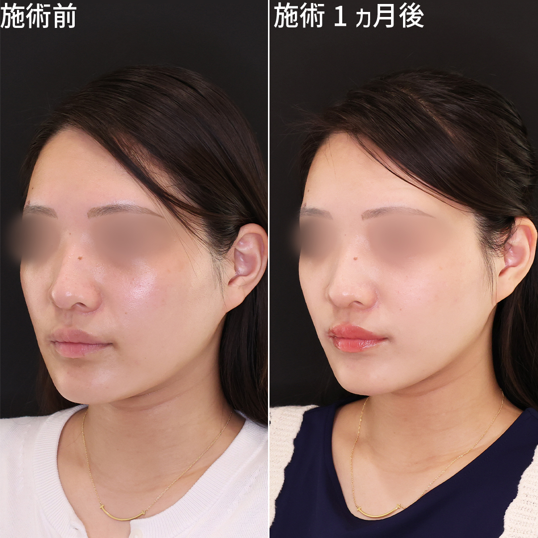 TAC式 ツヤ肌コラーゲンリフト®/ジョールファット除去/エラボトックス注射の症例写真 施術前後