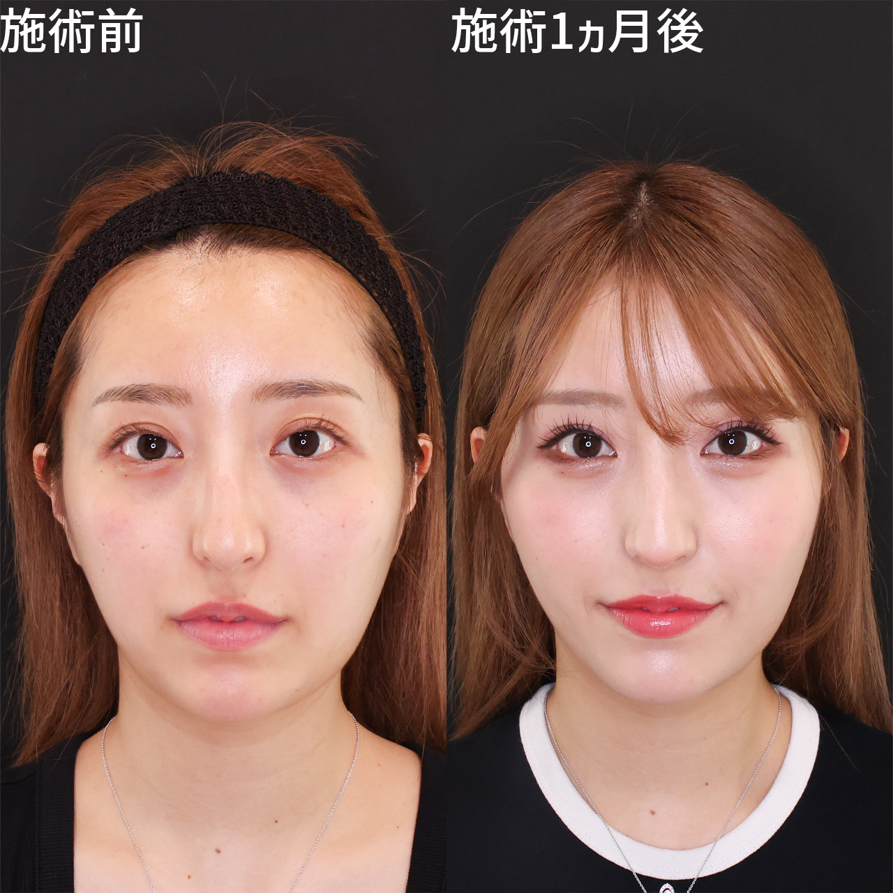 口横のもたつきが改善し小顔美人に♪美人小顔脂肪吸引ならDr.モリモリ