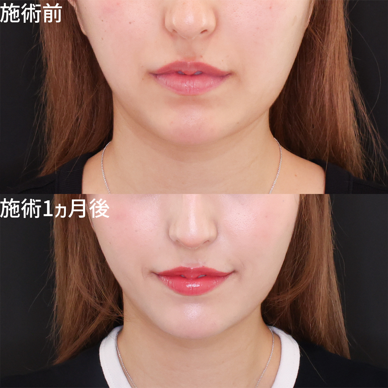 TAC式 ツヤ肌コラーゲンリフト®/ジョールファット除去/顔の脂肪吸引の症例写真 施術前後 