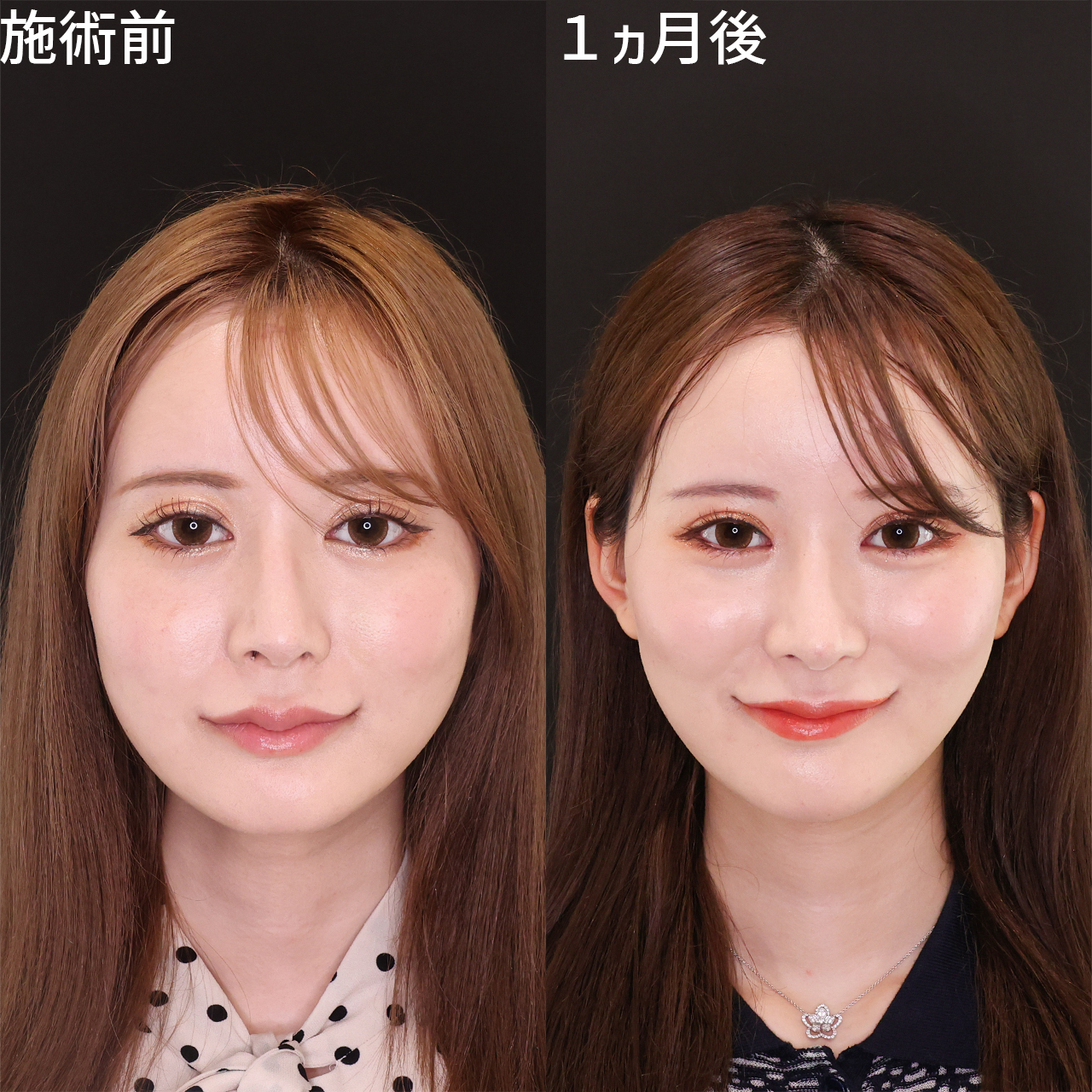 らむらむさんの小顔施術を担当しました！脂肪除去でさらに小顔美人に