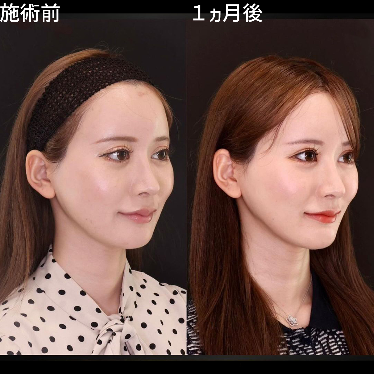 小顔整形｜パーフェクトフェイスライン/TAC式 ツヤ肌コラーゲンリフト®/ジョールファット除去の症例写真 施術前後 