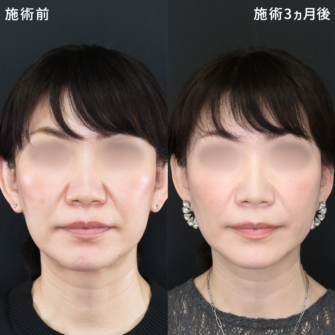 【-10才】輪郭とほうれい線改善｜若返り小顔施術