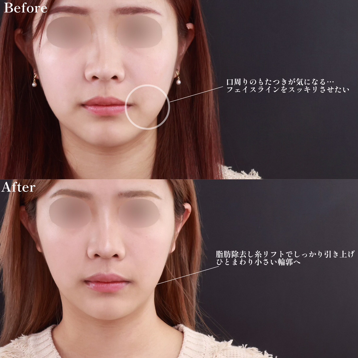 小顔整形｜パーフェクトフェイスライン/TAC式 ツヤ肌コラーゲンリフト®/ジョールファット除去の症例写真 施術前後 