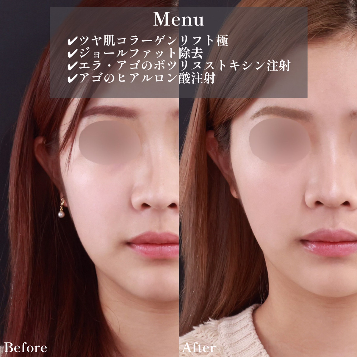 小顔整形｜パーフェクトフェイスライン/TAC式 ツヤ肌コラーゲンリフト®/ジョールファット除去の症例写真 施術前後 