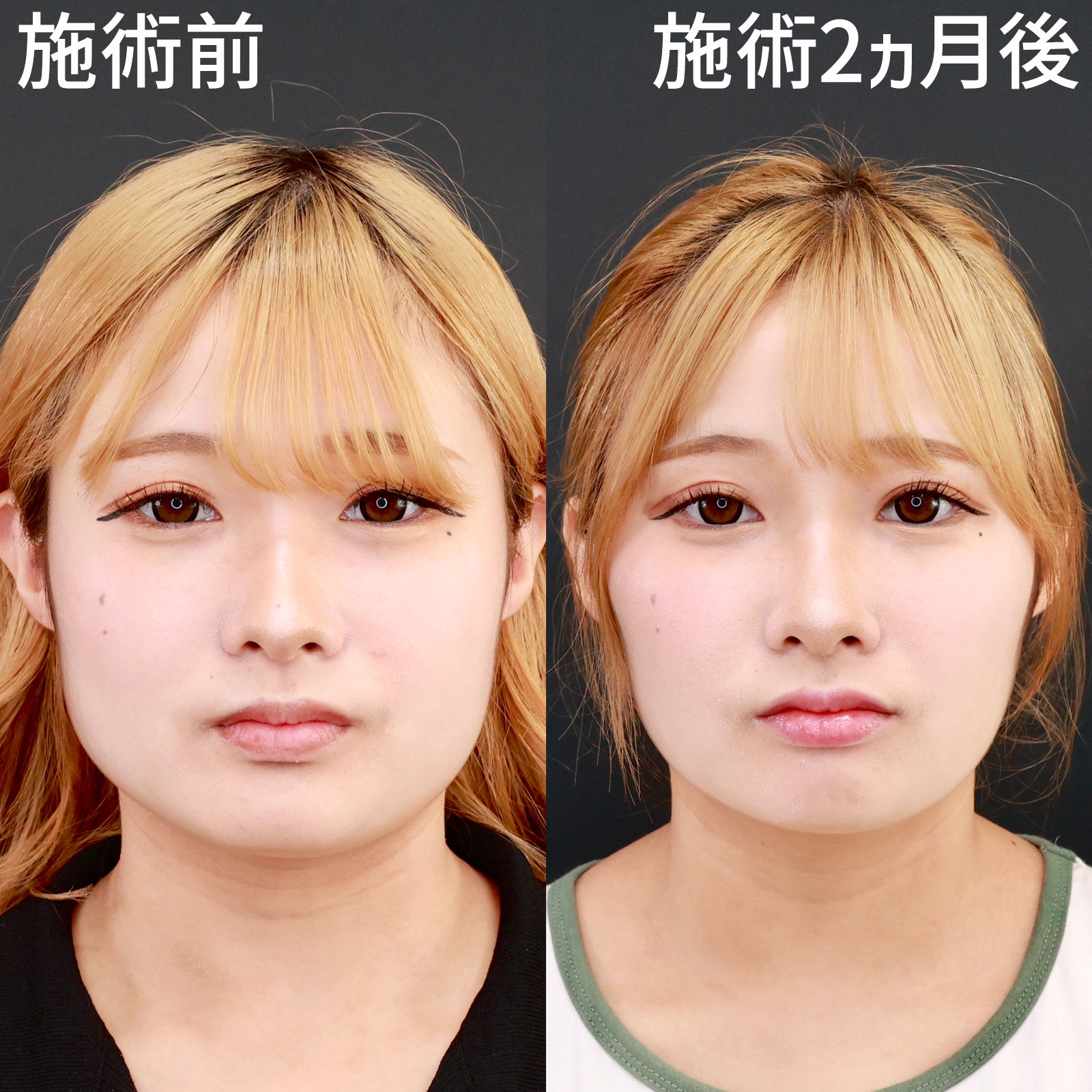 【小顔注射】バレにくい小顔整形なら、エラボツリヌストキシンがおすすめ！