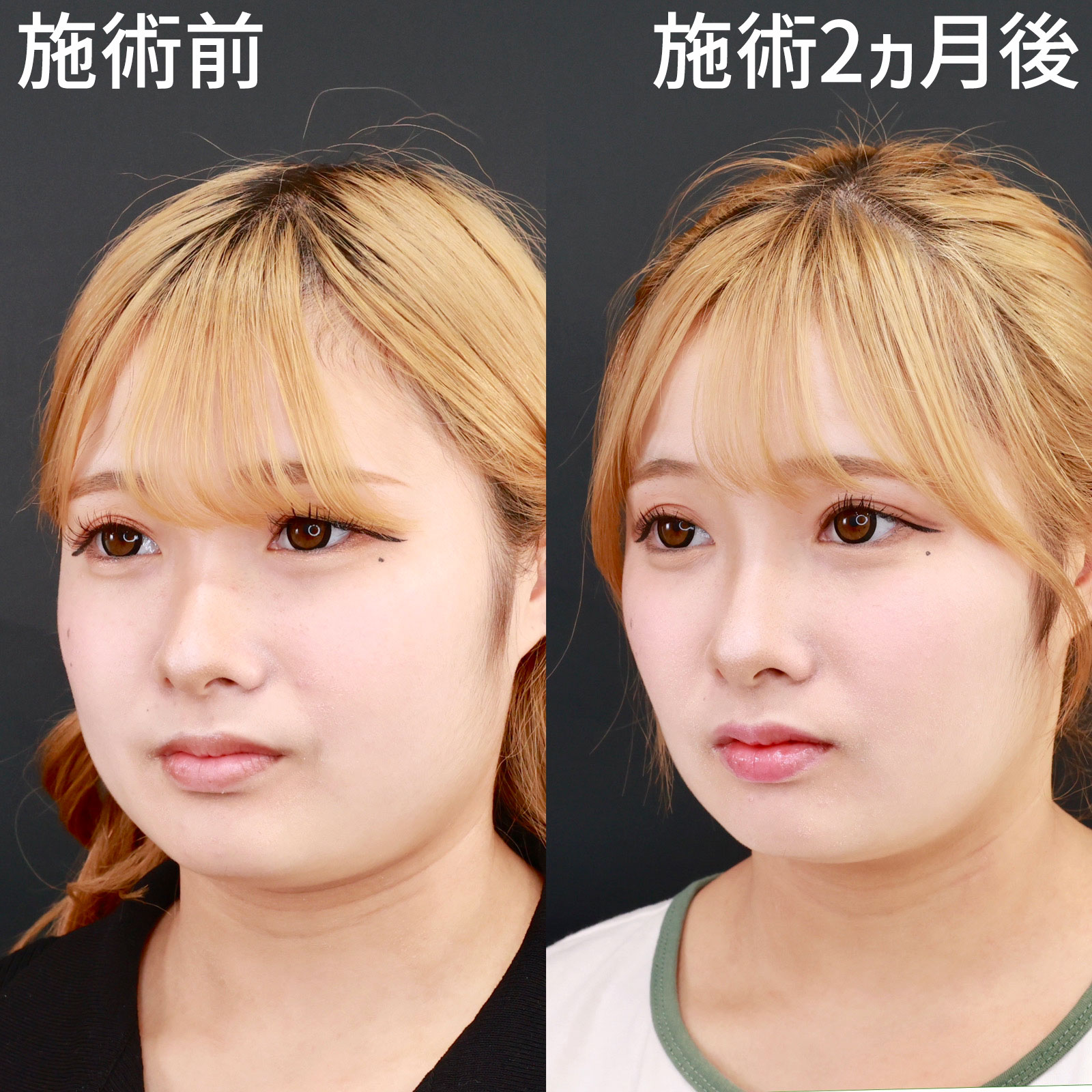 エラボトックス注射の症例写真 施術前後 