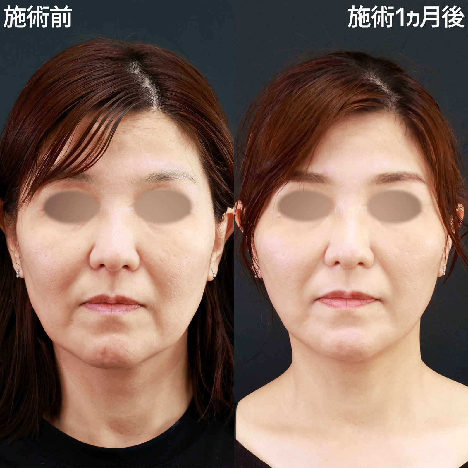 ジョールファット除去/メーラーファット除去/TAC式 ツヤ肌コラーゲンリフト®の症例写真 施術前後 