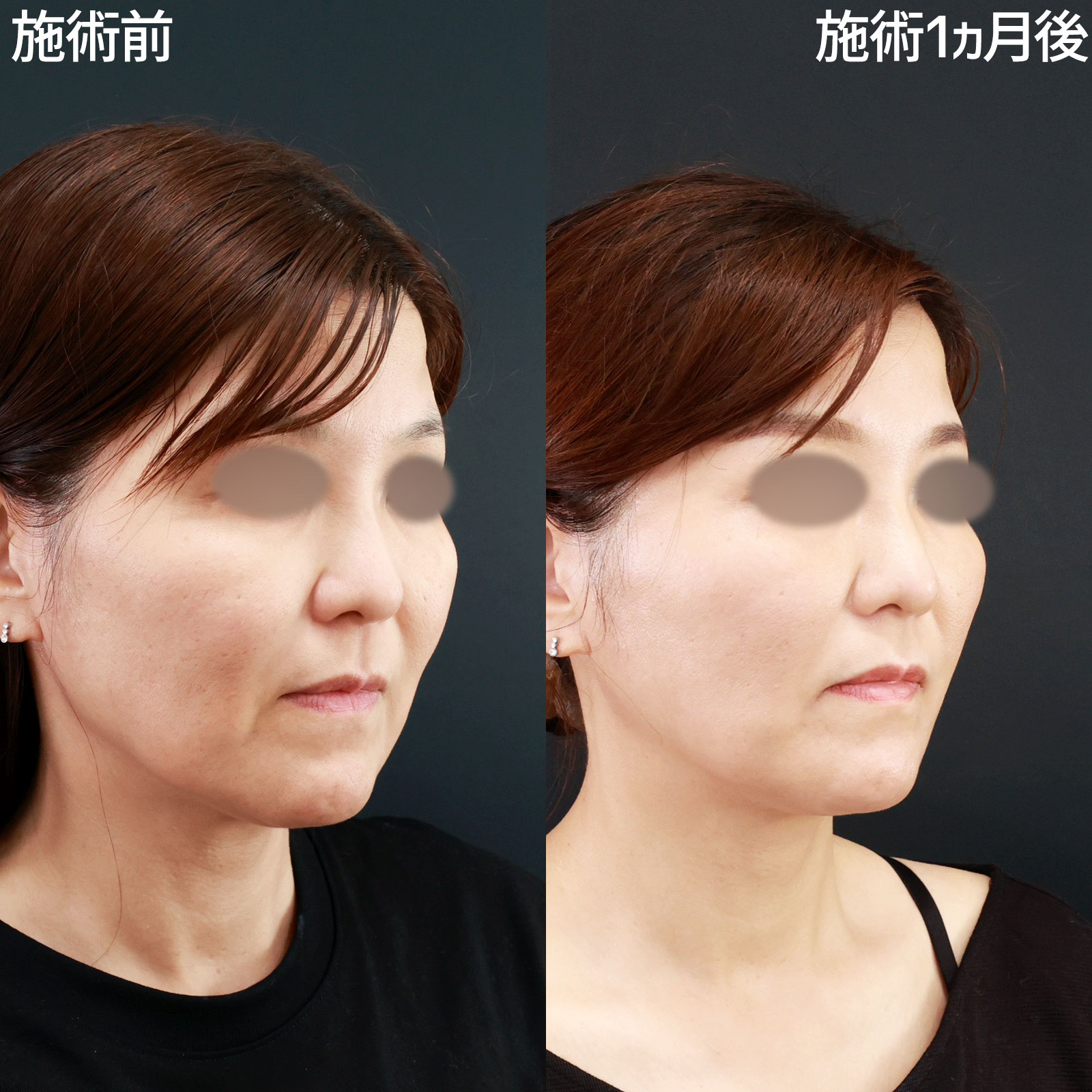 ジョールファット除去/メーラーファット除去/TAC式 ツヤ肌コラーゲンリフト®の症例写真 施術前後 