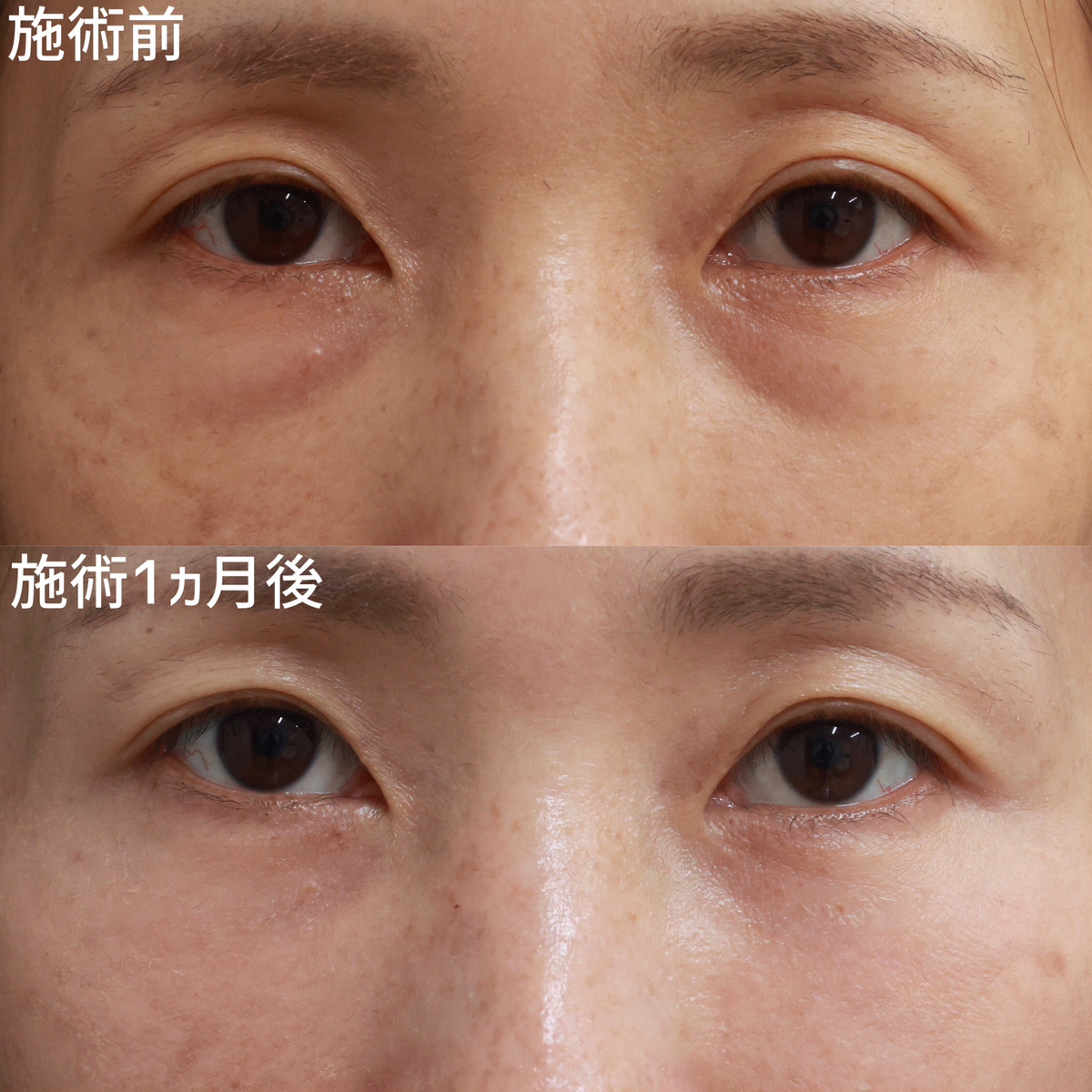 目の下のふくらみと色味を改善し、自信の持てる目元