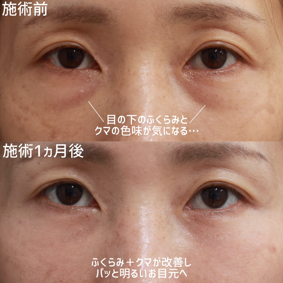下眼瞼脱脂術（目の下のたるみ取り・目の下の脂肪ふくらみ取り）/顔の脂肪注入(コンデンスリッチフェイス)の症例写真 施術前後 