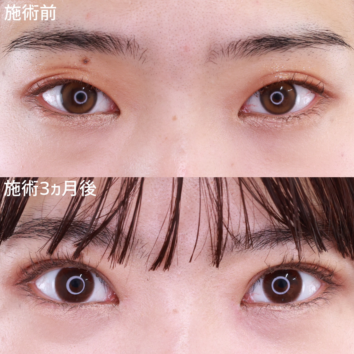 二重埋没法/目頭切開術/目元:その他の症例写真 施術前後