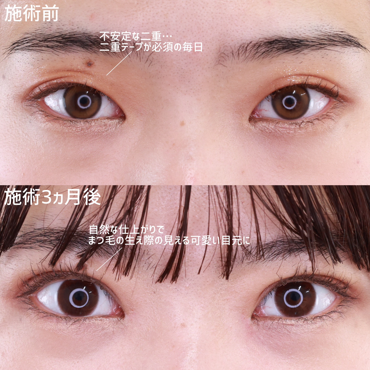 二重埋没法/目頭切開術/目元:その他の症例写真 施術前後