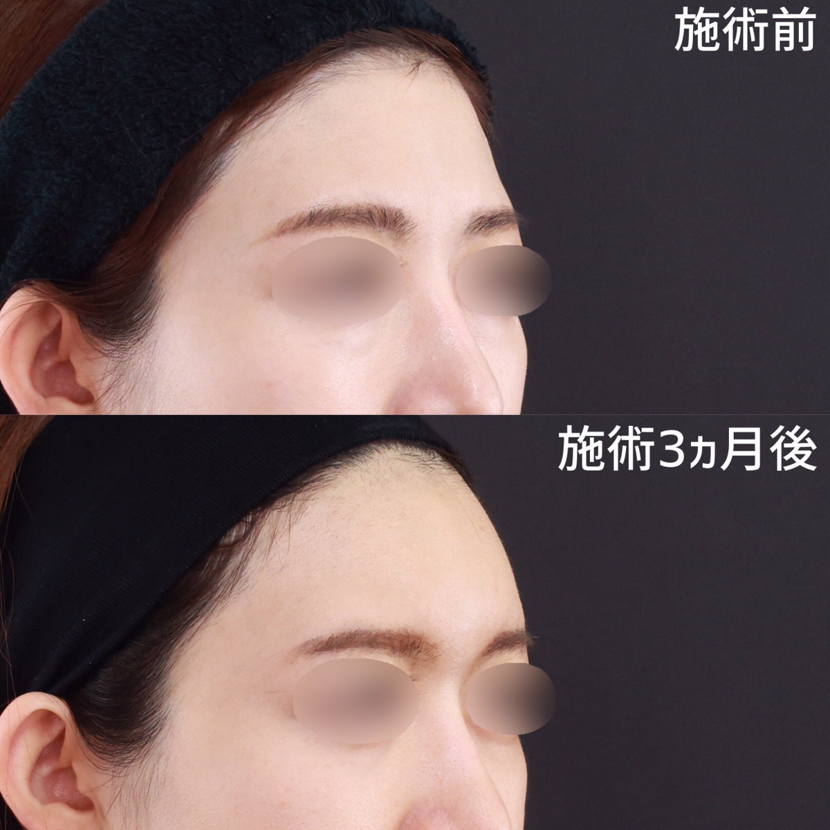 おでこの脂肪注入(オルチャンデコ形成)の症例写真 施術前後