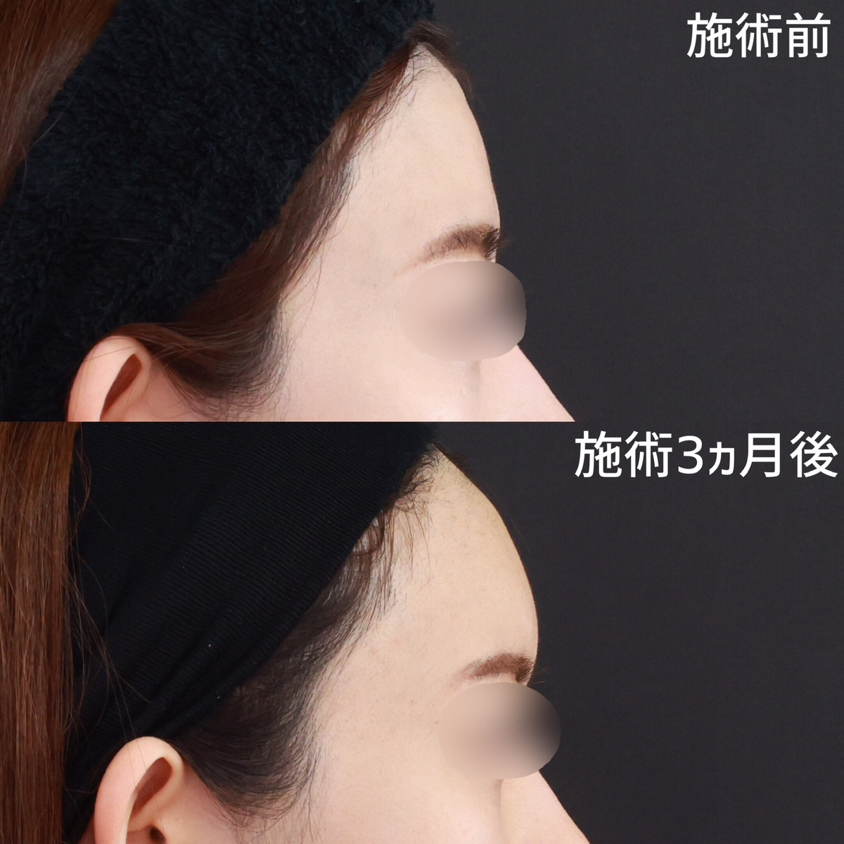 おでこの脂肪注入(オルチャンデコ形成)の症例写真 施術前後