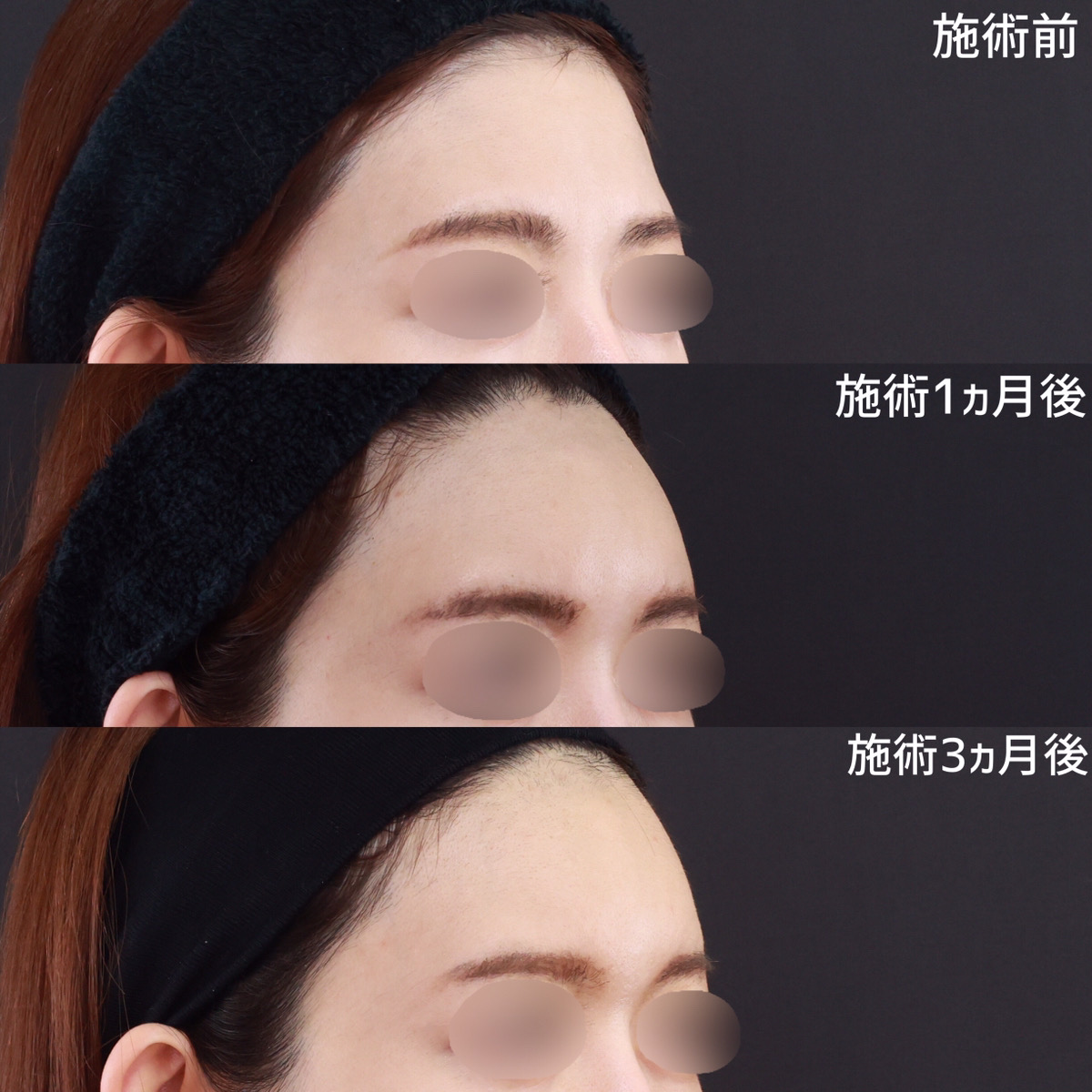 おでこの脂肪注入(オルチャンデコ形成)の症例写真 施術前後