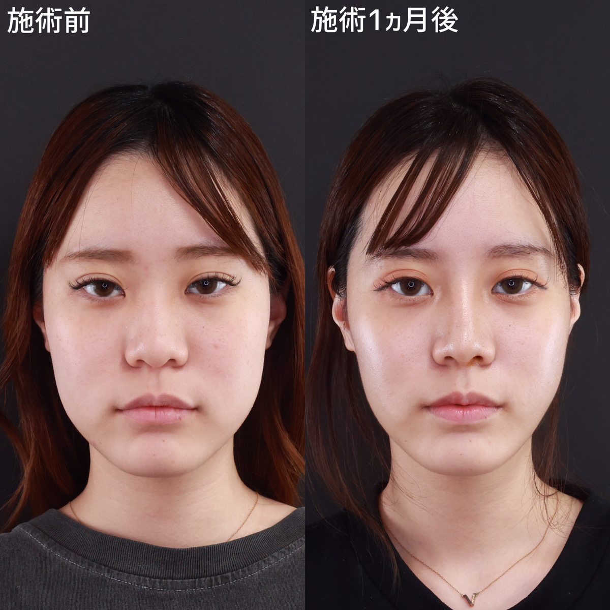 鼻中隔延長術/鼻先軟骨移植/鼻尖形成・鼻尖縮小の症例写真 施術前後 