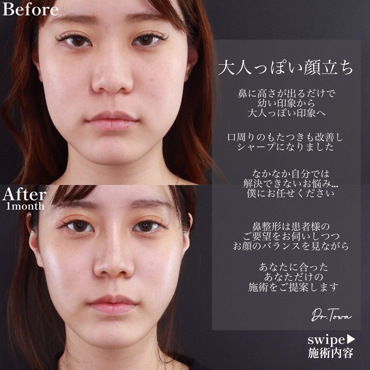 鼻中隔延長術/鼻先軟骨移植/鼻尖形成・鼻尖縮小の症例写真 施術前後 