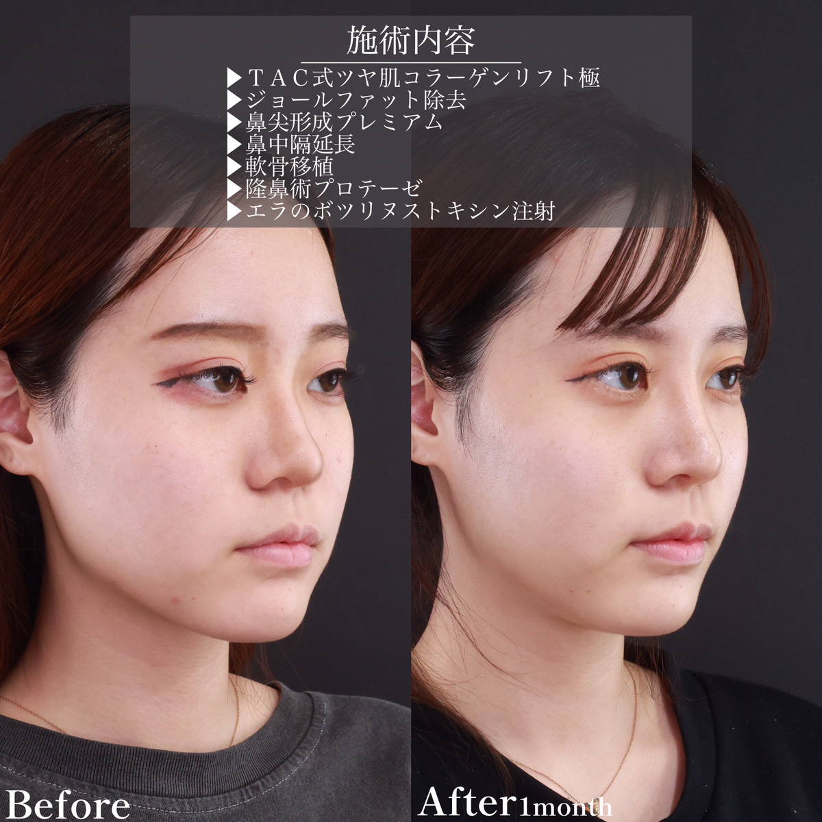 鼻中隔延長術/鼻先軟骨移植/鼻尖形成・鼻尖縮小の症例写真 施術前後 