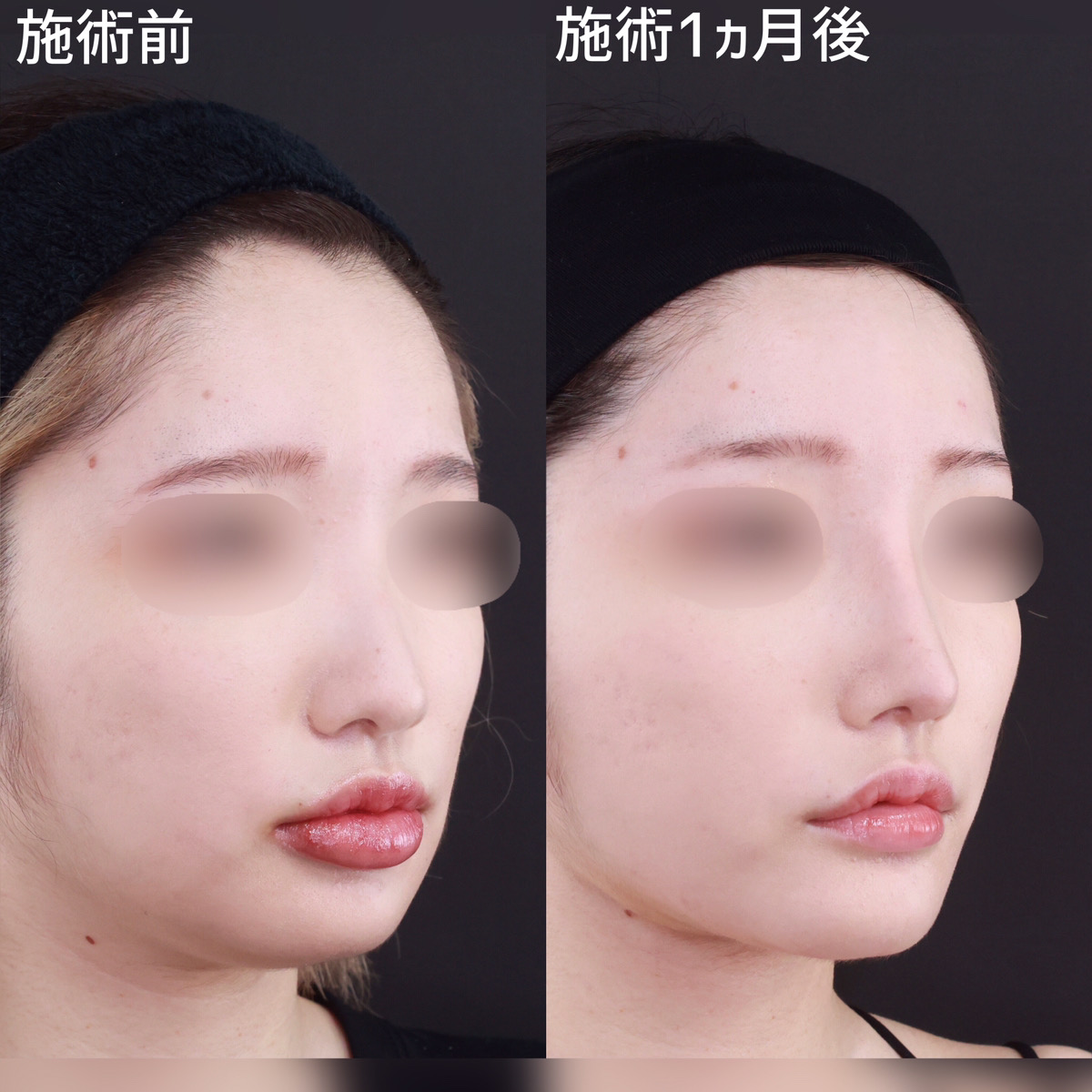 鼻先軟骨移植/鼻尖形成・鼻尖縮小/隆鼻術（プロテーゼ・自家組織）の症例写真 施術前後 