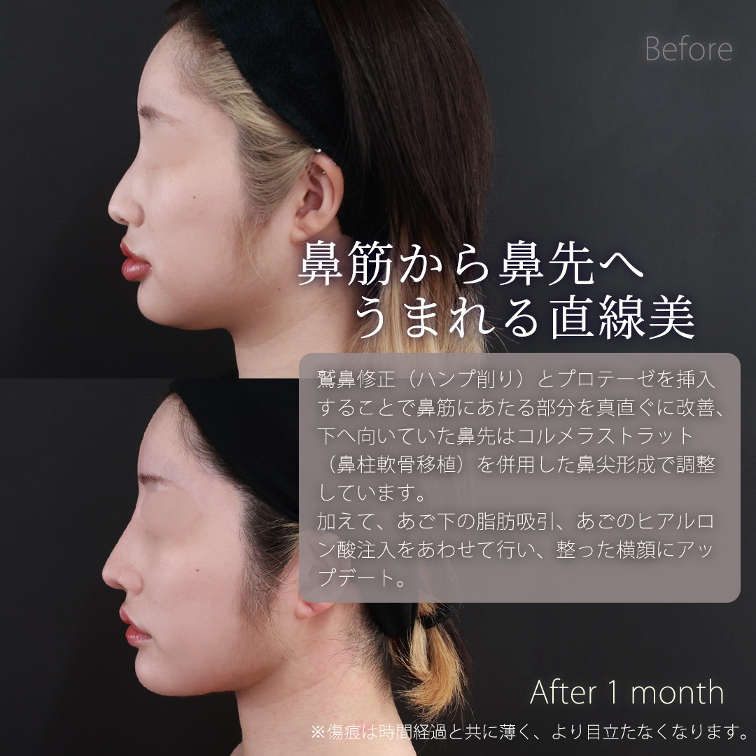 鼻先軟骨移植/鼻尖形成・鼻尖縮小/隆鼻術（プロテーゼ・自家組織）の症例写真 施術前後 