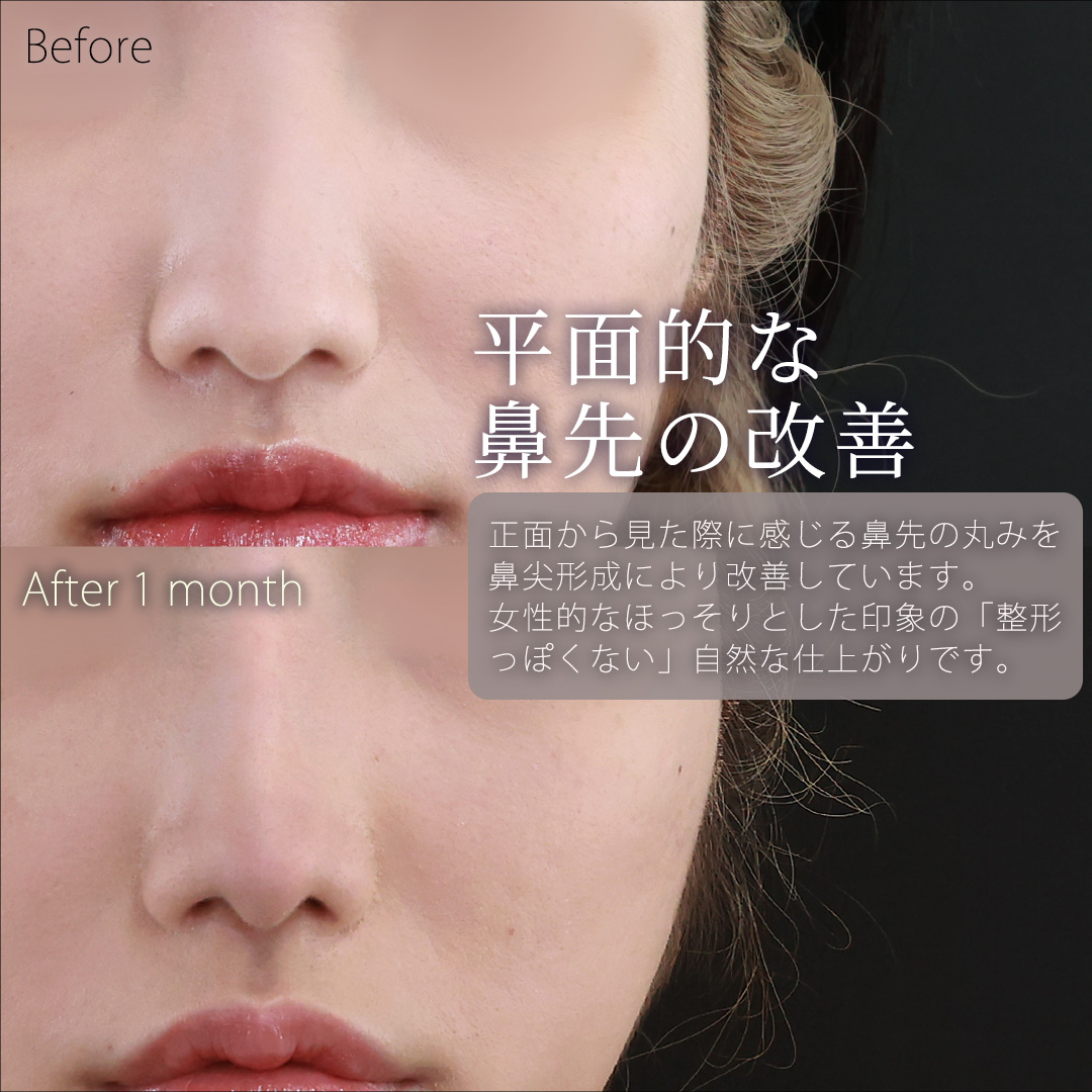 鼻先軟骨移植/鼻尖形成・鼻尖縮小/隆鼻術（プロテーゼ・自家組織）の症例写真 施術前後 