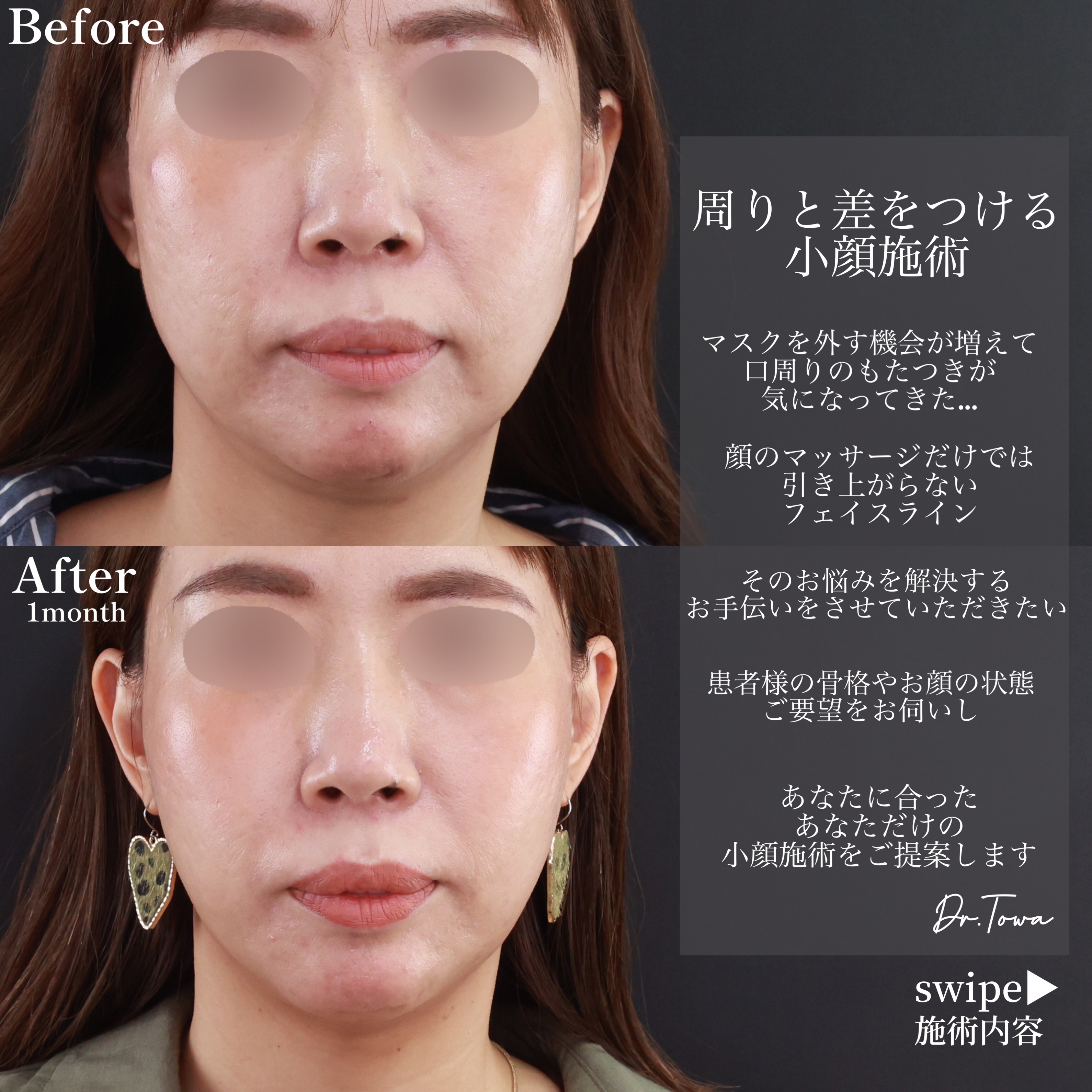 小顔整形｜パーフェクトフェイスライン/ジョールファット除去/エラボトックス注射の症例写真 施術前後 