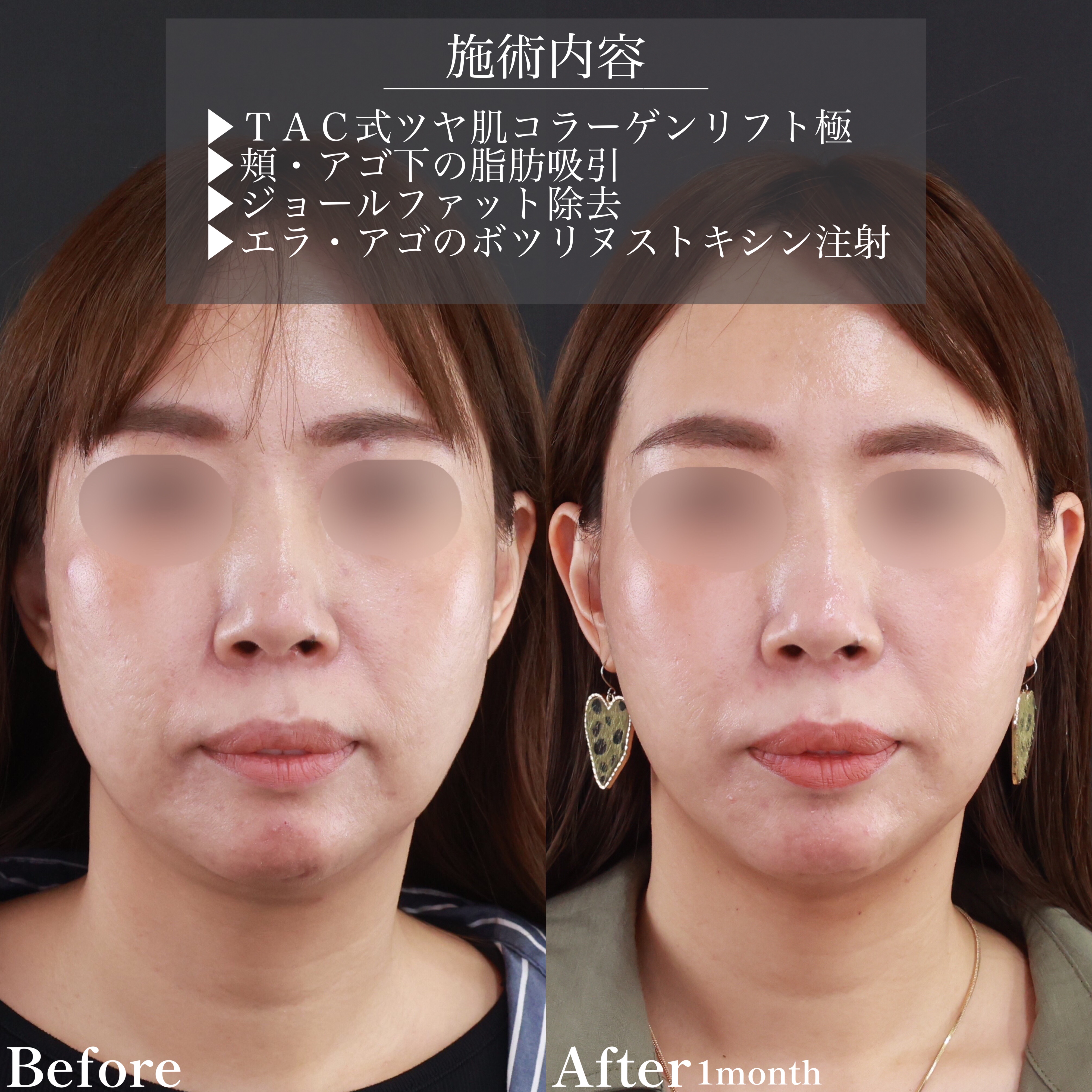 小顔整形｜パーフェクトフェイスライン/ジョールファット除去/エラボトックス注射の症例写真 施術前後 