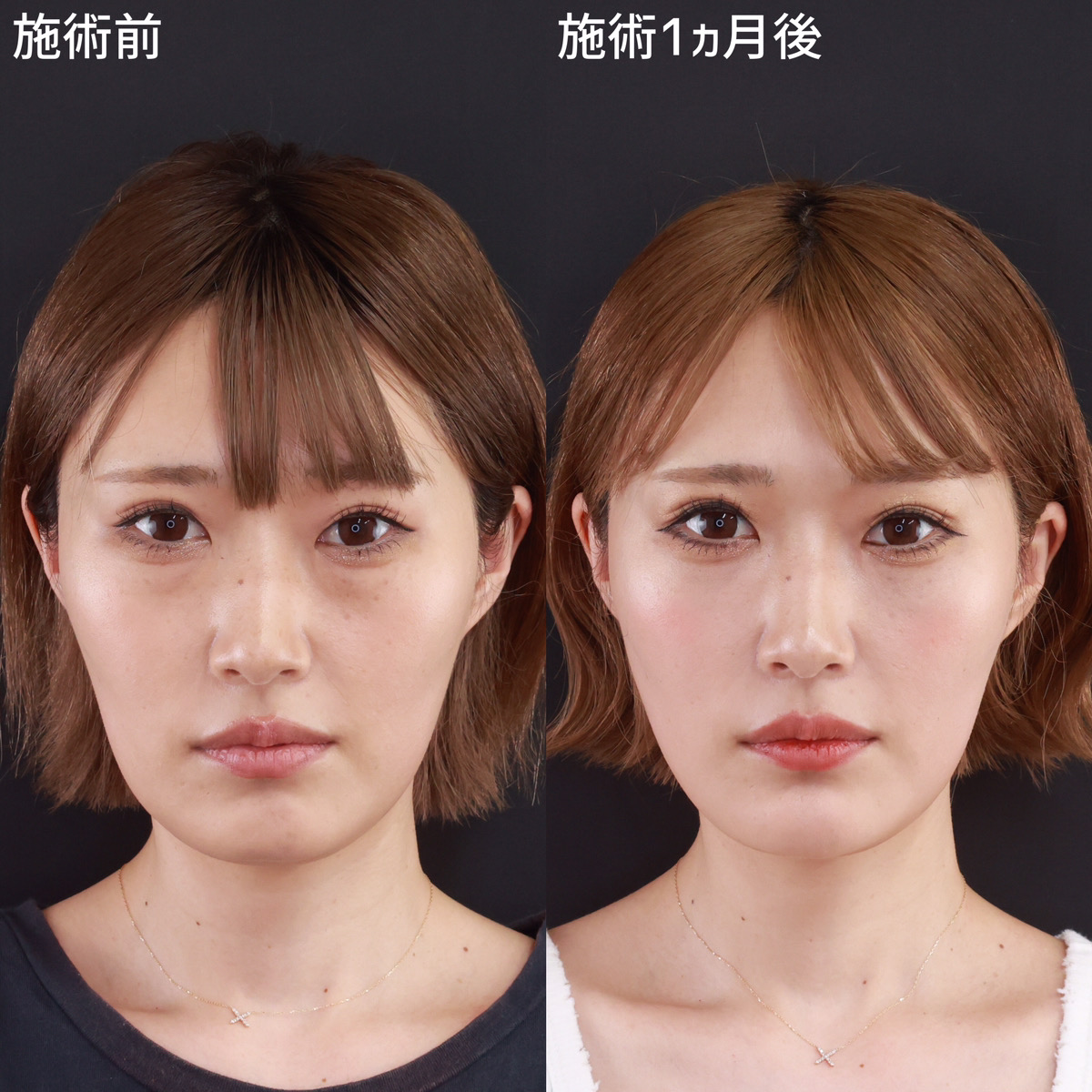 下眼瞼脱脂術(目の下のたるみ取り・目の下の脂肪ふくらみ取り)/TAC式 ツヤ肌コラーゲンリフト®/小顔整形|パーフェクトフェイスラインの症例写真 施術前後