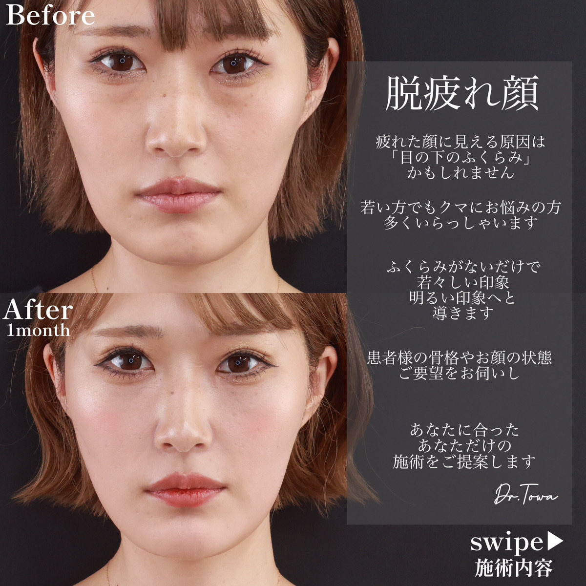 下眼瞼脱脂術(目の下のたるみ取り・目の下の脂肪ふくらみ取り)/TAC式 ツヤ肌コラーゲンリフト®/小顔整形|パーフェクトフェイスラインの症例写真 施術前後