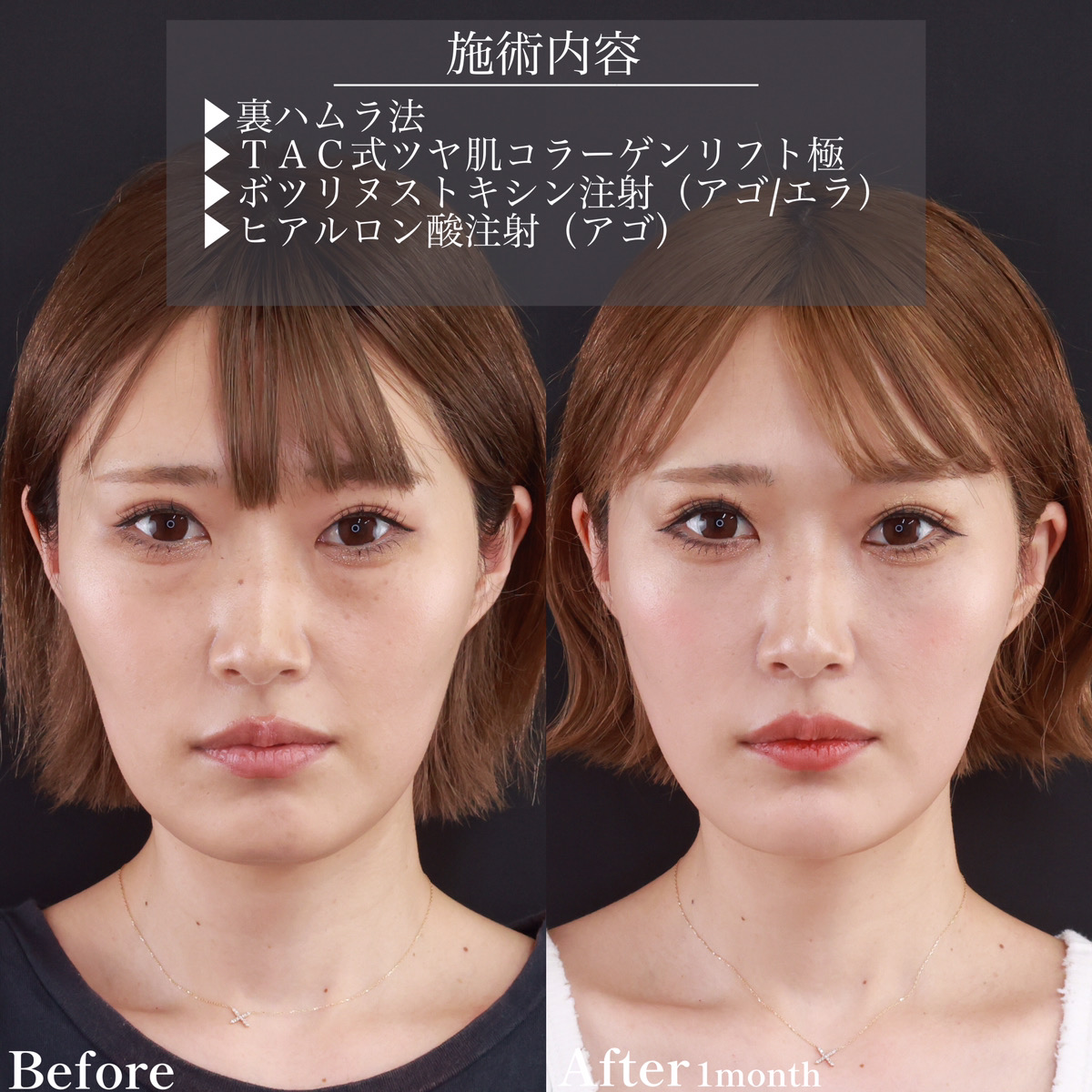 下眼瞼脱脂術(目の下のたるみ取り・目の下の脂肪ふくらみ取り)/TAC式 ツヤ肌コラーゲンリフト®/小顔整形|パーフェクトフェイスラインの症例写真 施術前後