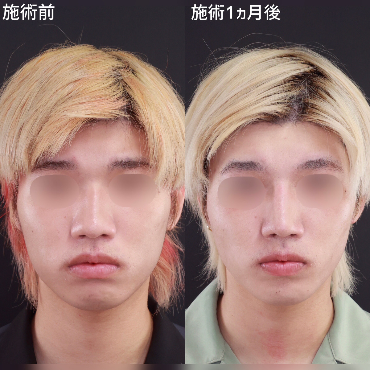 鼻先軟骨移植/鼻尖形成・鼻尖縮小/隆鼻術（プロテーゼ・自家組織）の症例写真 施術前後 