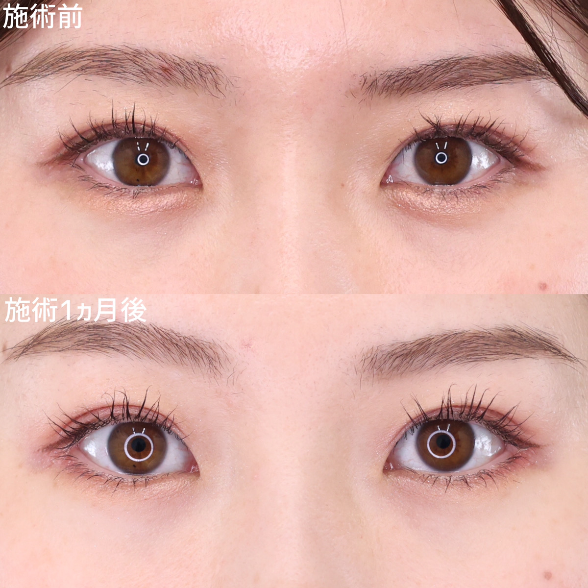 【タレ目尻切開】つり目を改善し、自然に目を大きく！