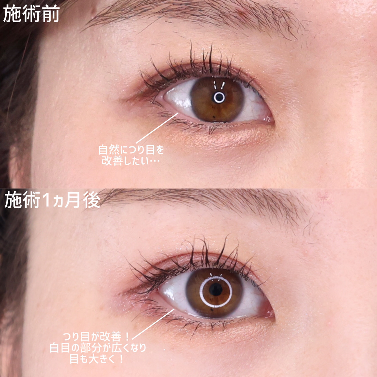 目尻切開術/目尻靭帯移動術の症例写真 施術前後 