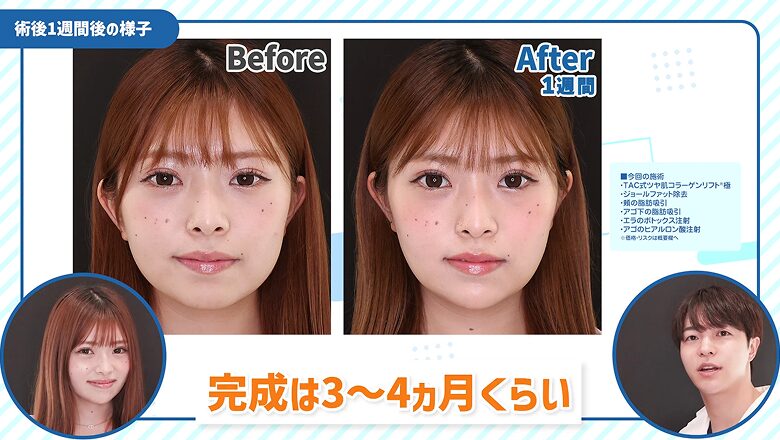 小顔整形施術前と術後1週間後の正面比較写真