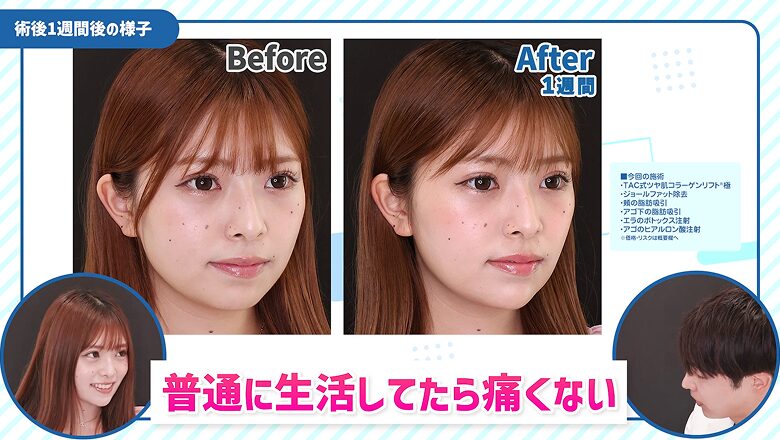 小顔整形施術前と術後1週間後の斜め横顔の比較写真