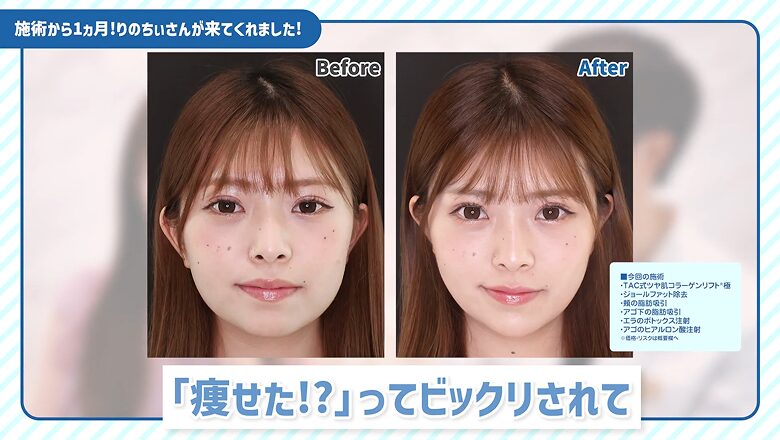 術後1カ月が経過しさらに引き締まった輪郭の比較写真