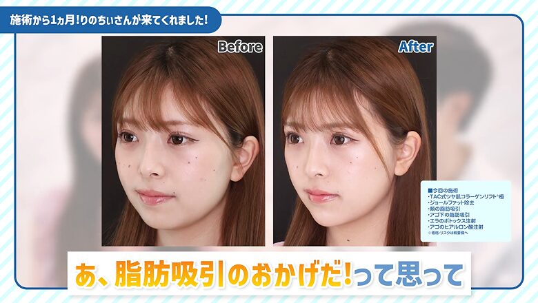 小顔整形の術前と術後1ヶ月の斜め横顔比較写真