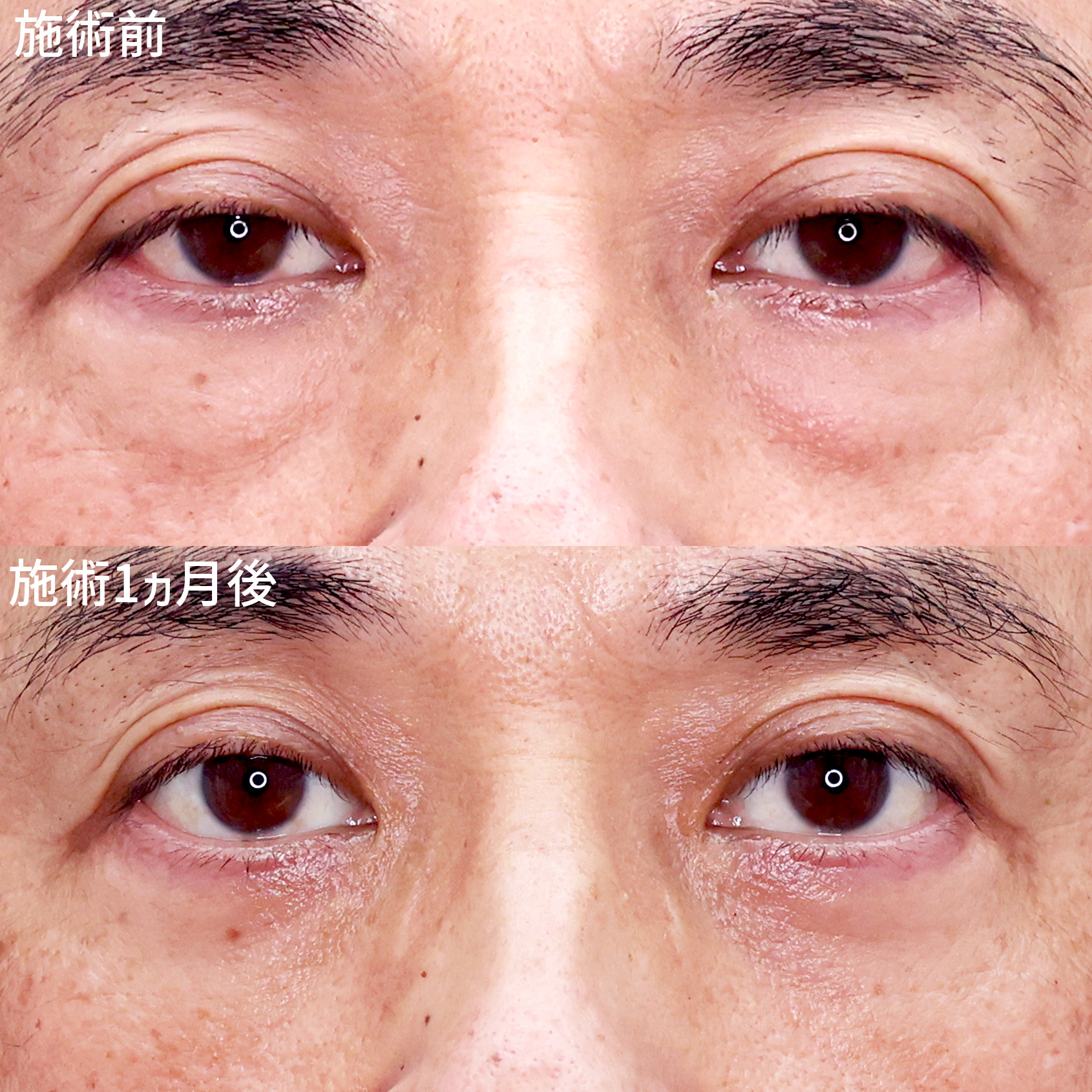 目の下の凹凸を解消。健康的な目元に！【クマ・ふくらみ取り】