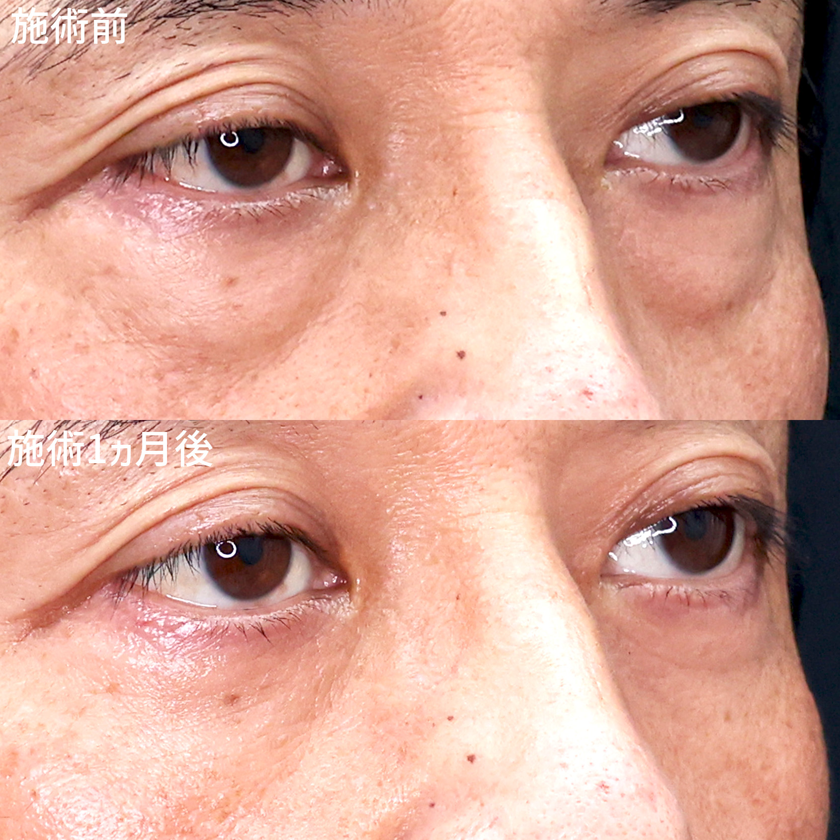 下眼瞼脱脂術（目の下のたるみ取り・目の下の脂肪ふくらみ取り）の症例写真 施術前後 