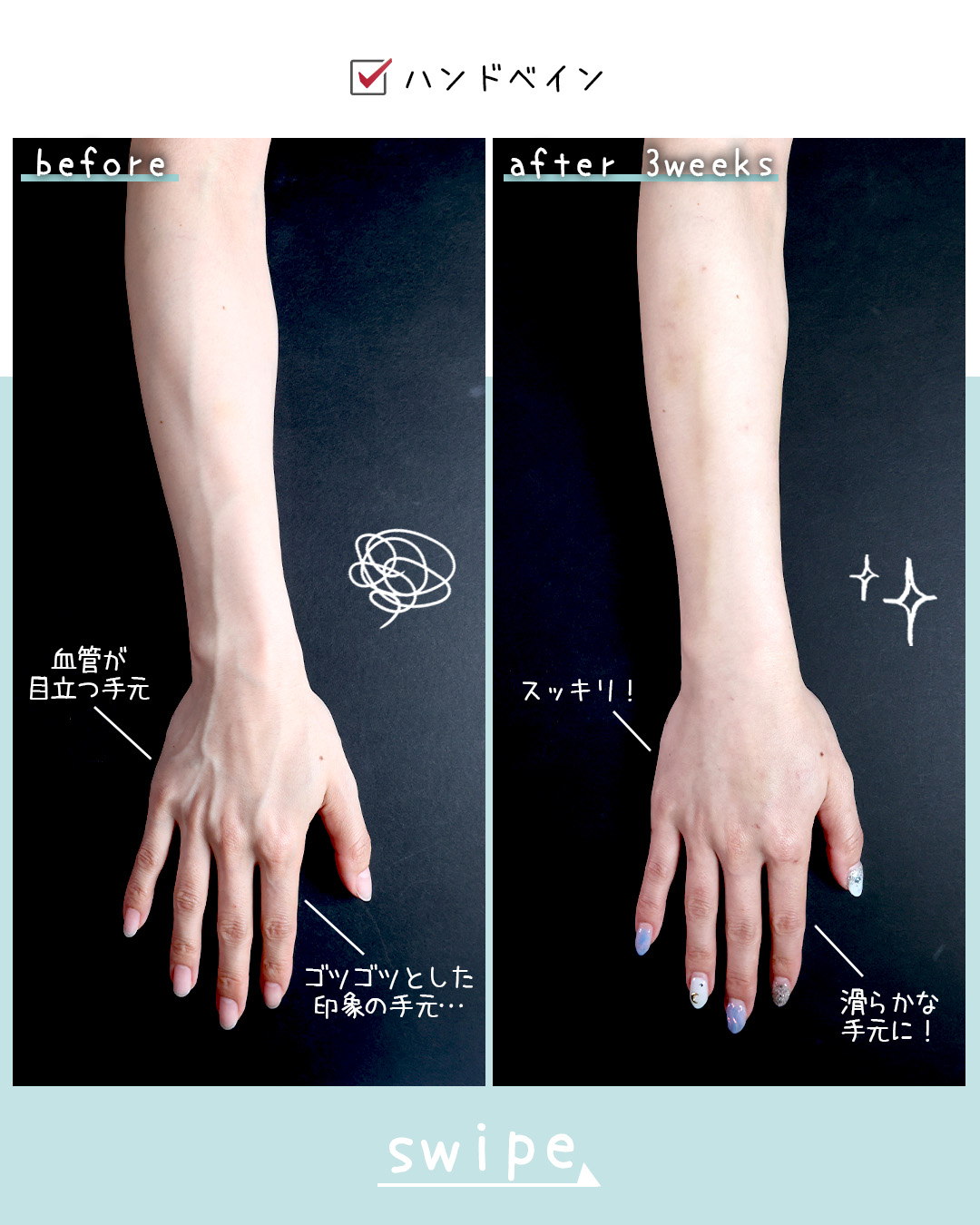 ハンドベイン（手のアンチエイジング・血管治療）の症例写真 施術前後 3週間