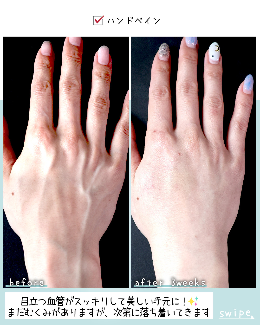 ハンドベイン（手のアンチエイジング・血管治療）の症例写真 施術前後 3週間