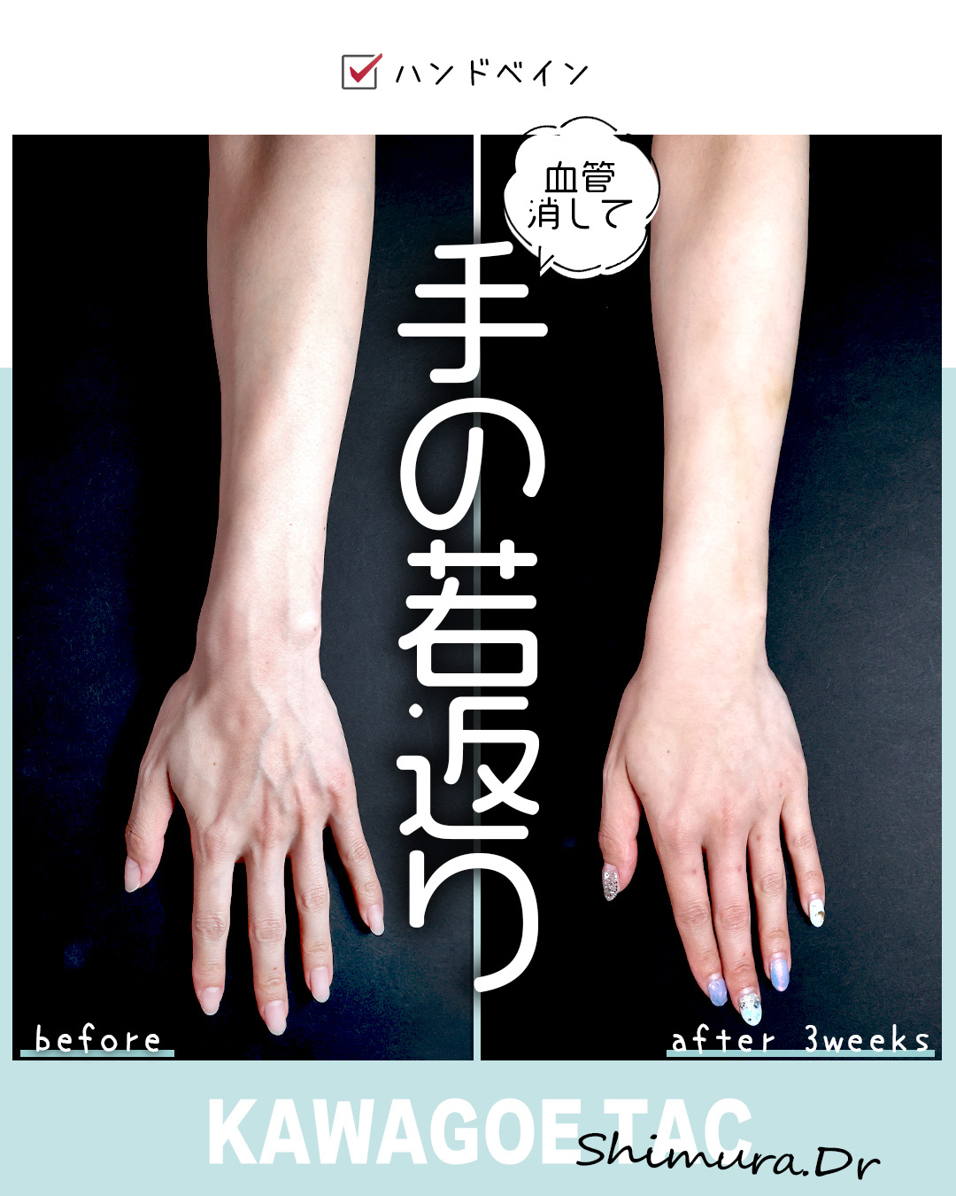 ハンドベイン（手のアンチエイジング・血管治療）の症例写真 施術前後 3週間