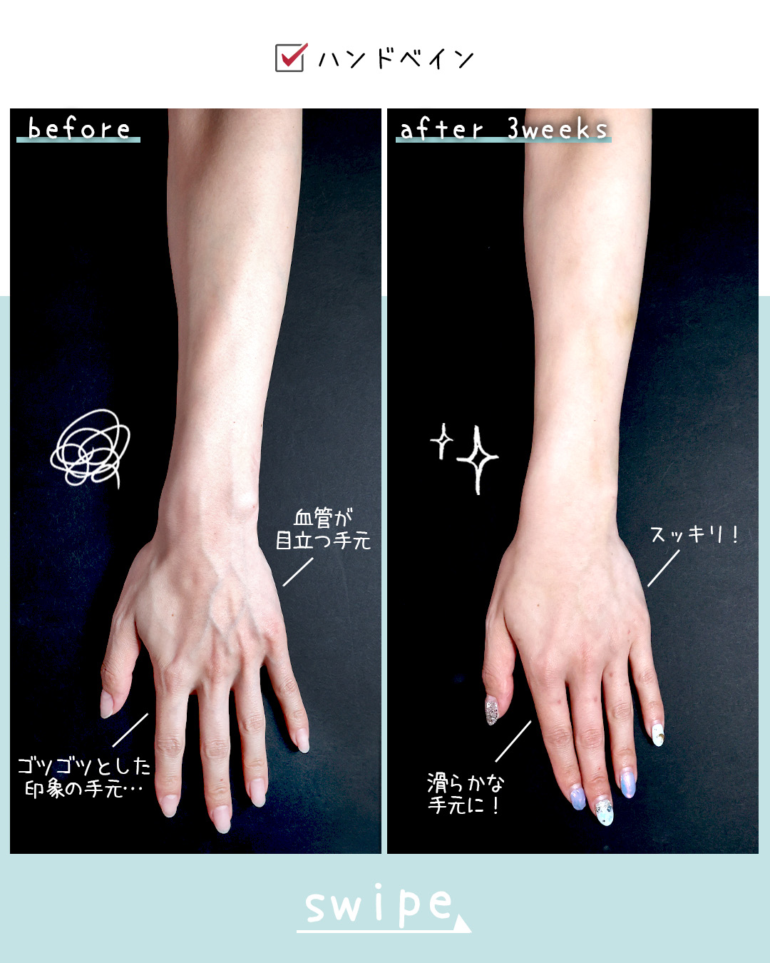 ハンドベイン（手のアンチエイジング・血管治療）の症例写真 施術前後 3週間
