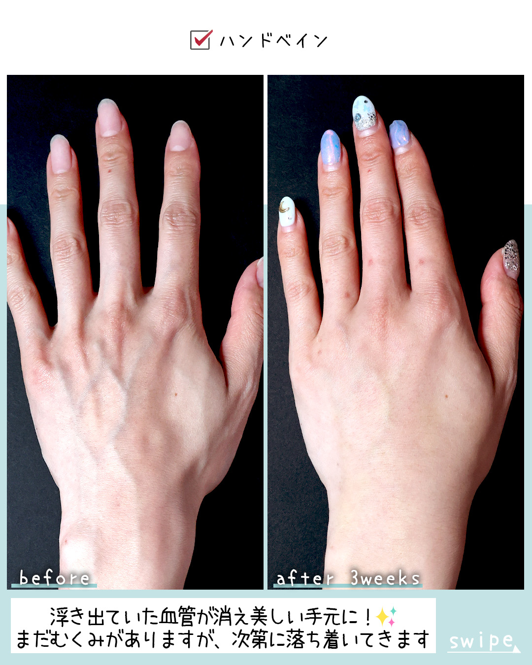 ハンドベイン（手のアンチエイジング・血管治療）の症例写真 施術前後 3週間