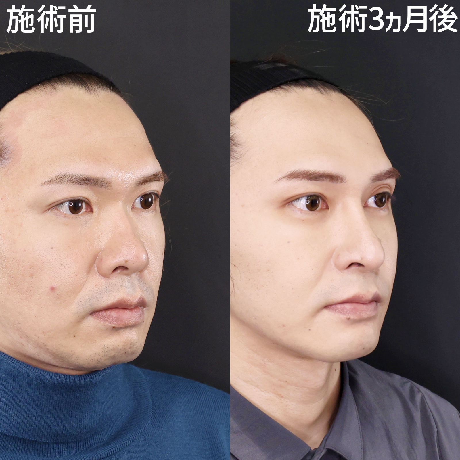 鼻中隔延長術/鼻先軟骨移植/鼻尖形成・鼻尖縮小の症例写真 施術前後 