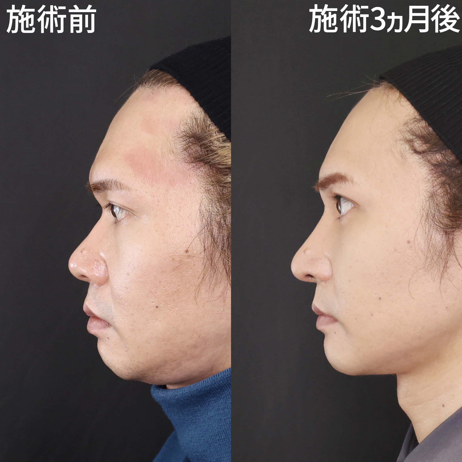 鼻中隔延長術/鼻先軟骨移植/鼻尖形成・鼻尖縮小の症例写真 施術前後 