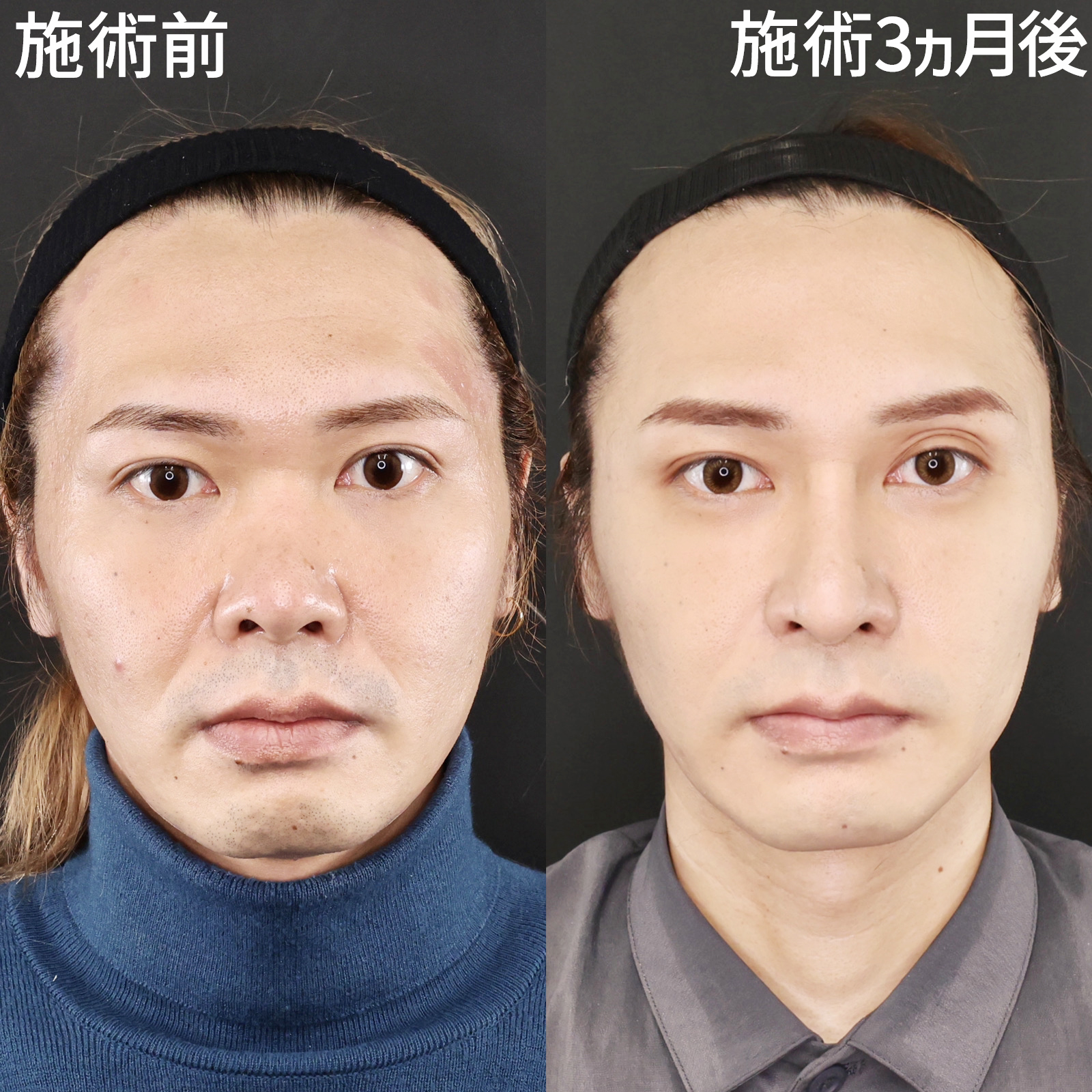 【鼻中隔延長】鼻フル整形で360度見ても洗練された印象のお顔に！