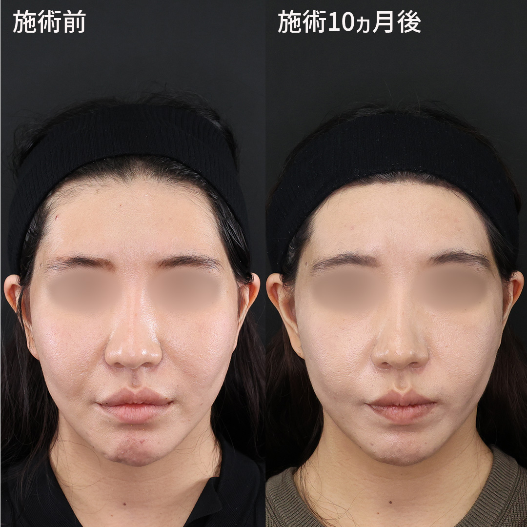 フェイスリフト（切開）の症例写真 施術前後 