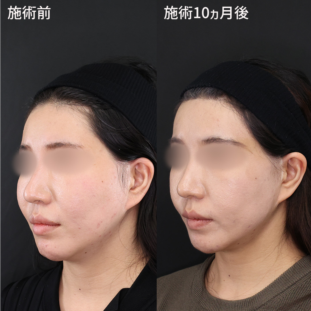 フェイスリフト（切開）の症例写真 施術前後 